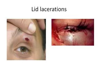 Lid lacerations