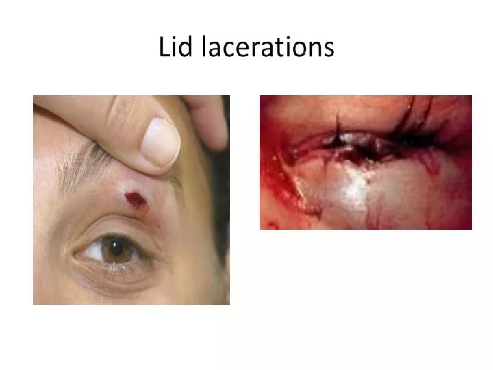 lid lacerations
