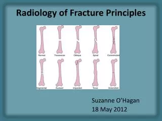 radiology of fracture principles