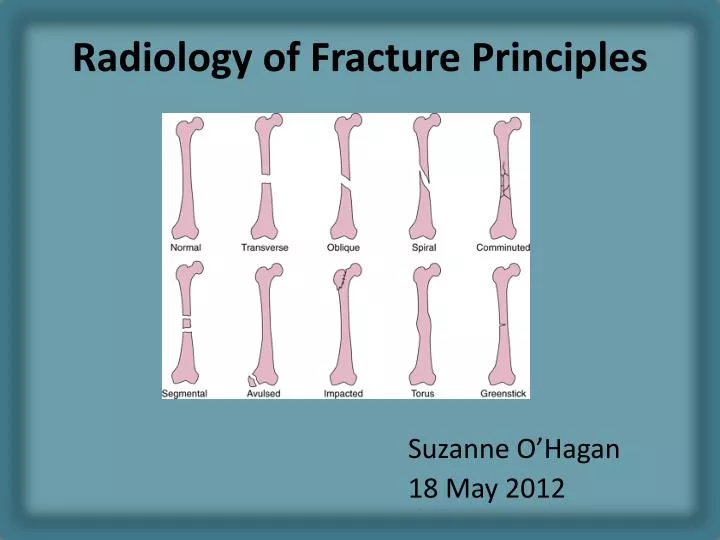 radiology of fracture principles
