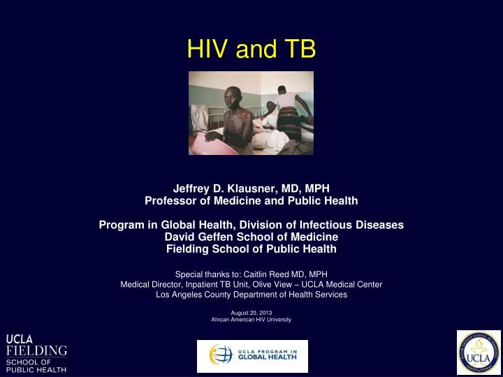 hiv and tb