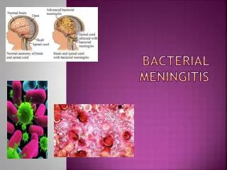 Bacterial Meningitis