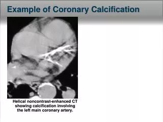 Helical noncontrast-enhanced CT showing calcification involving the left main coronary artery.