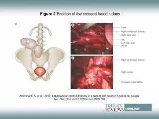 Figure 2 Position of the crossed fused kidney