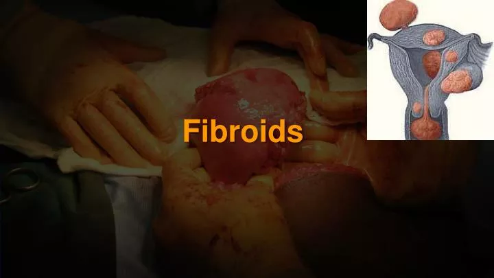 fibroids