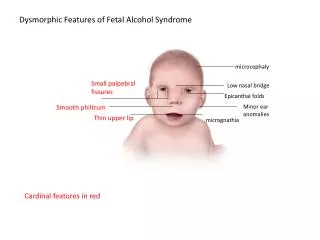 Dysmorphic Features of Fetal Alcohol Syndrome