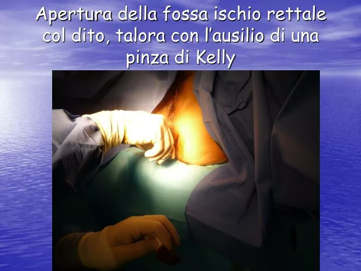 apertura della fossa ischio rettale col dito talora con l ausilio di una pinza di kelly