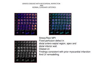 Stress/Rest MPI Fixed perfusion defect in distal antero-septal region, apex and distal inferior wall. Dilated LV.