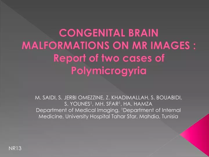 congenital brain malformations on mr images report of two cases of polymicrogyria