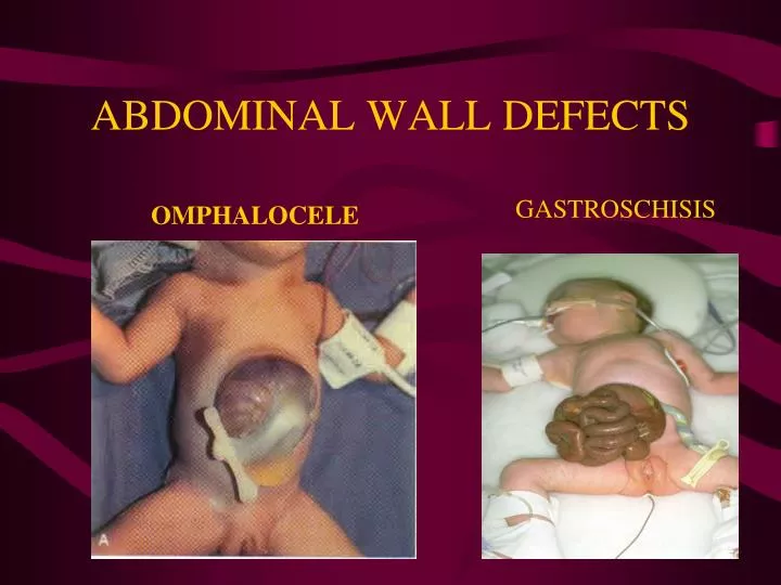 abdominal wall defects