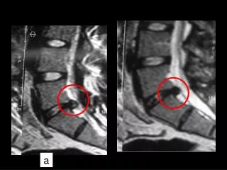 Lumbar disc herniation