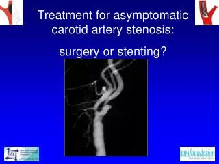Treatment for asymptomatic carotid artery stenosis: surgery or stenting?