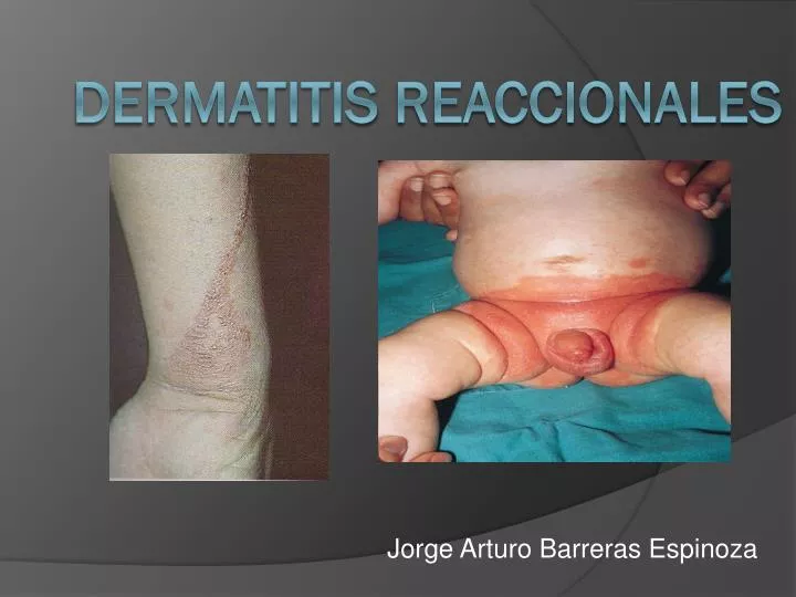 dermatitis reaccionales