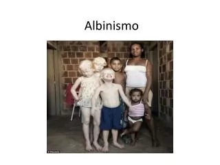albinismo