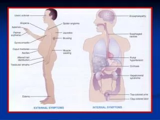 Pathophysiology of Ascites