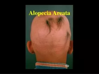 Alopecia Areata