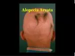 Alopecia Areata - slide 1