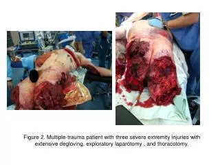 Figure 2. Multiple-trauma patient with three severe extremity injuries with extensive degloving, exploratory laparotomy