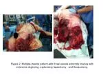 Figure 2. Multiple-trauma patient with three severe extremity injuries with extensive degloving, exploratory laparotomy - slide 1