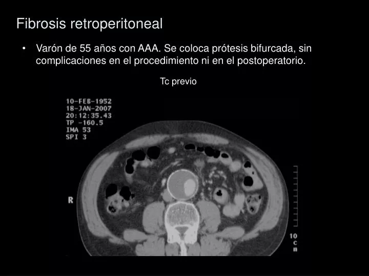 fibrosis retroperitoneal