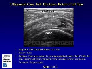Ultrasound Case: Full Thickness Rotator Cuff Tear