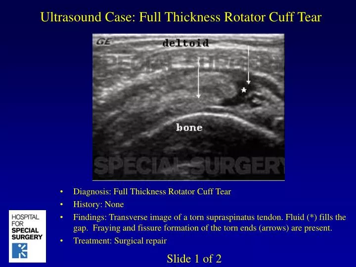 ultrasound case full thickness rotator cuff tear