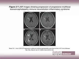 Figure 2 FLAIR images showing progression of progressive multifocal leukoencephalopathy immune reconstitution inflammat