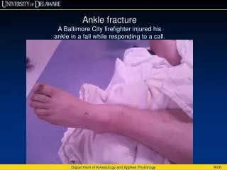 Ankle fracture A Baltimore City firefighter injured his ankle in a fall while responding to a call.