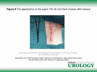 Figure 8 The appearance of the supra-11th rib mini-flank incision after closure