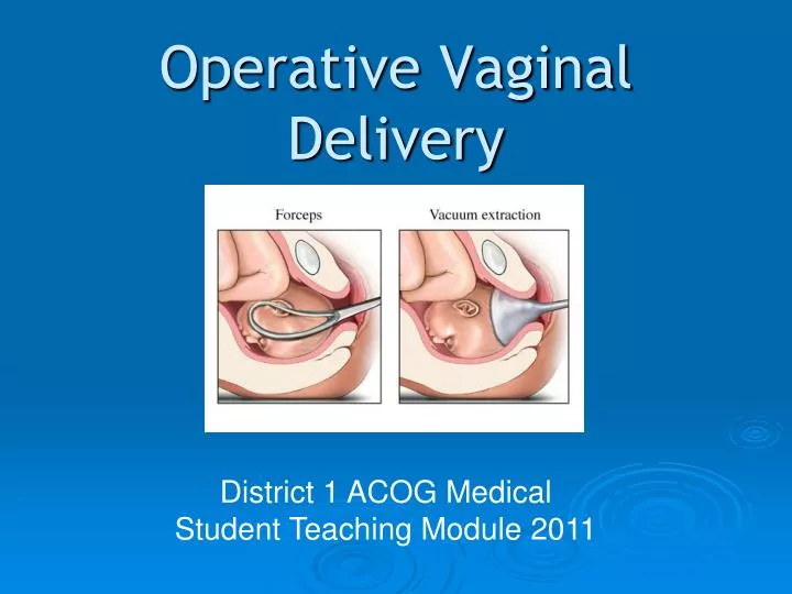 operative vaginal delivery