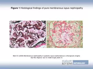 Figure 1 Histological findings of pure membranous lupus nephropathy