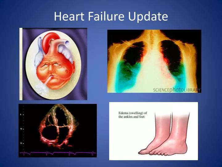 heart failure update