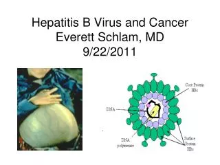 Hepatitis B Virus and Cancer Everett Schlam, MD 9/22/2011