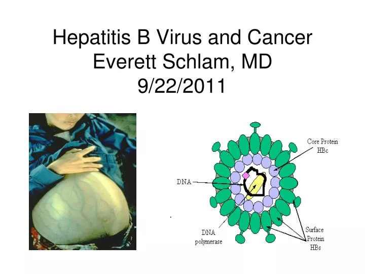hepatitis b virus and cancer everett schlam md 9 22 2011