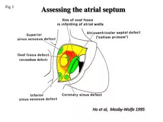 Assessing the atrial septum