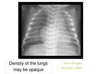 Chest AP supine Boy 6 hours, MAS