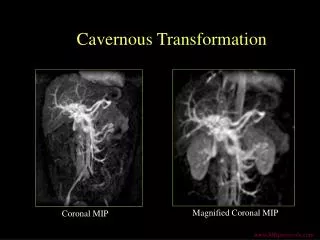 Cavernous Transformation