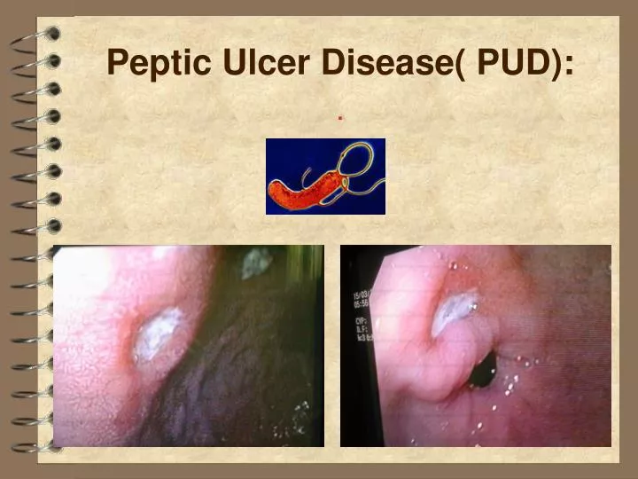 peptic ulcer disease pud