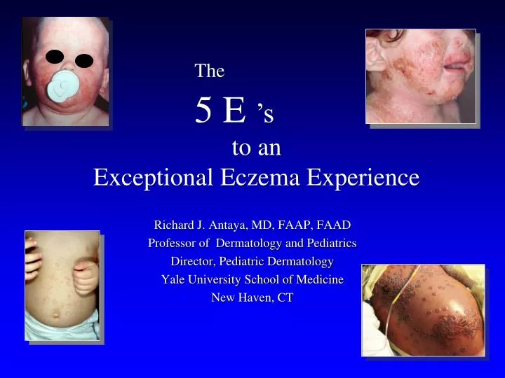 to an exceptional eczema experience