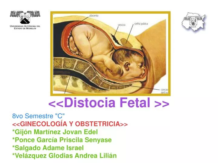 distocia fetal