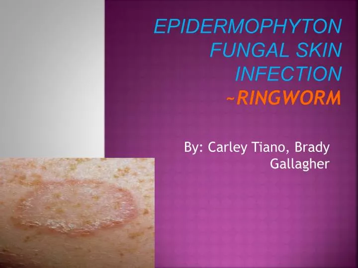 epidermophyton fungal skin infection ringworm