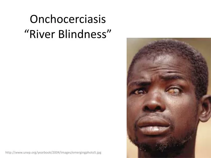 onchocerciasis river blindness