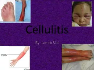 Cellulitis