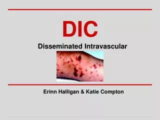 DIC Disseminated Intravascular Coagulation