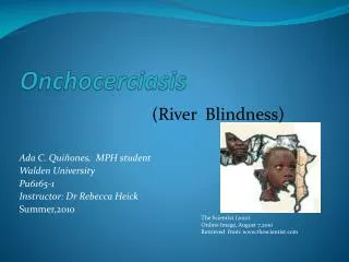 Onchocerciasis