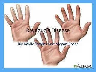 raynaud s disease