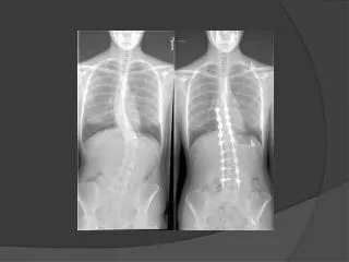 Scoliosis- explained