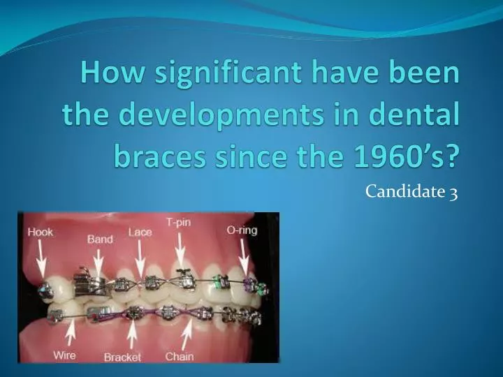 how significant have been the developments in dental braces since the 1960 s