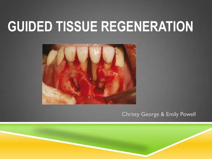 guided tissue regeneration