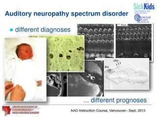Auditory neuropathy spectrum disorder